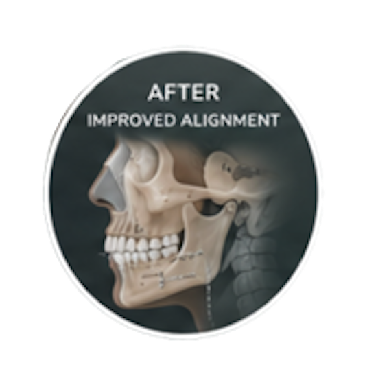 After corrective jaw surgery