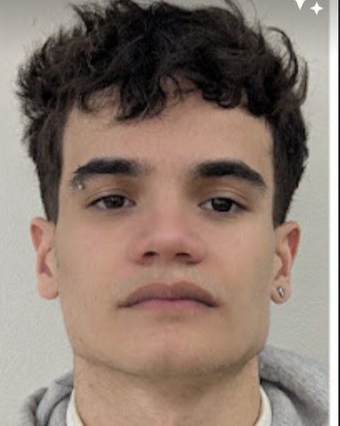 Patient 1 after orthognathic surgery, frontal view