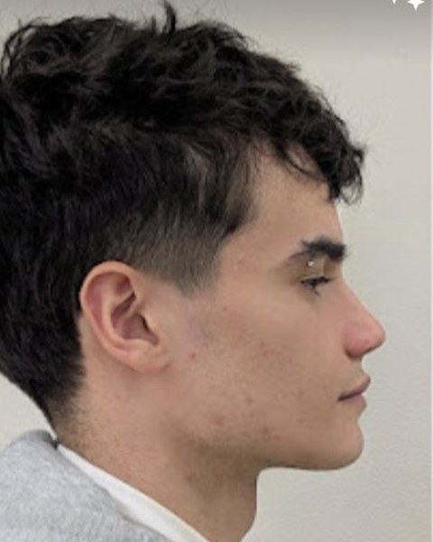 Patient 1 after orthognathic surgery, profile view