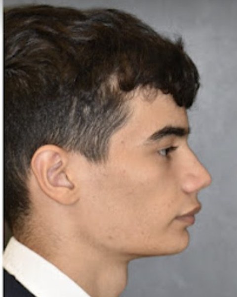 Patient 1 before orthognathic surgery, profile view