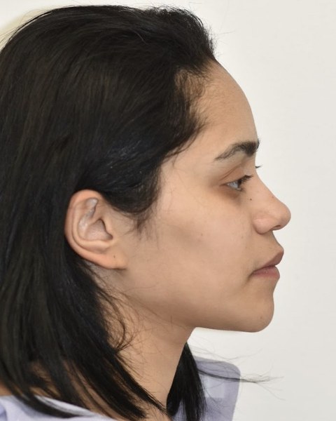 Patient 2 after orthognathic surgery, profile view