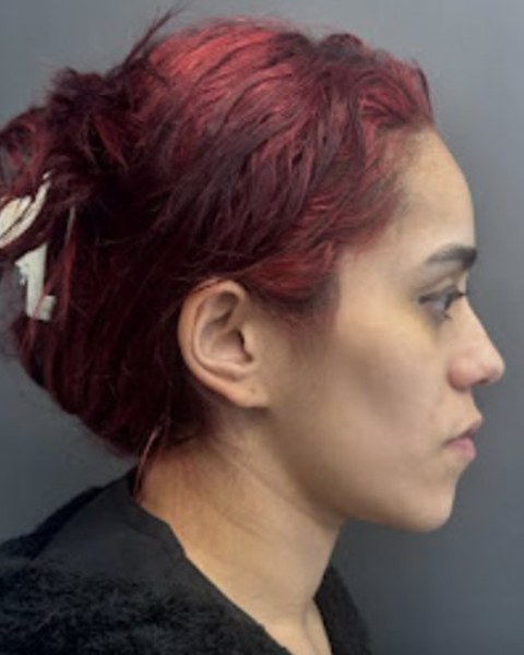 Patient 2 before orthognathic surgery, profile view