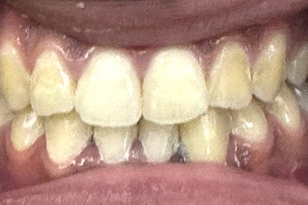 Patient 2 bite after orthognathic surgery