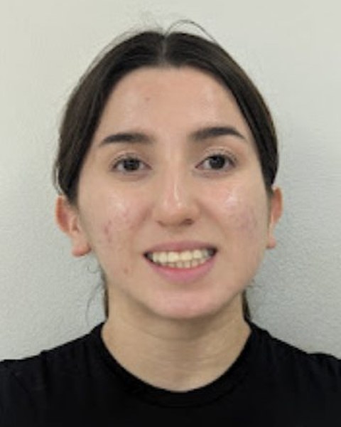 Patient 3 before orthognathic surgery, frontal view
