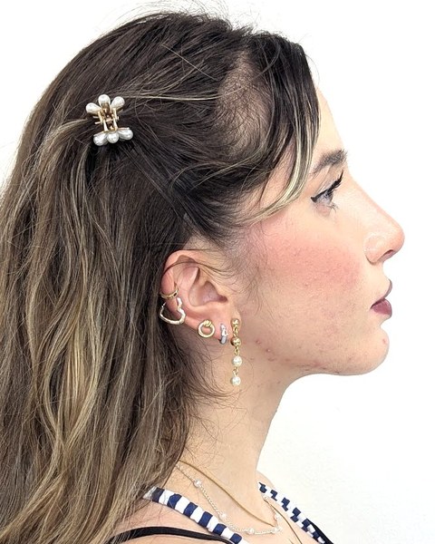 Patient 3 after orthognathic surgery, profile view
