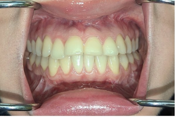 Patient 3 bite after orthognathic surgery