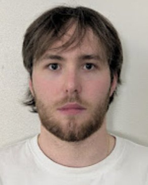 Patient 4 before orthognathic surgery, frontal view