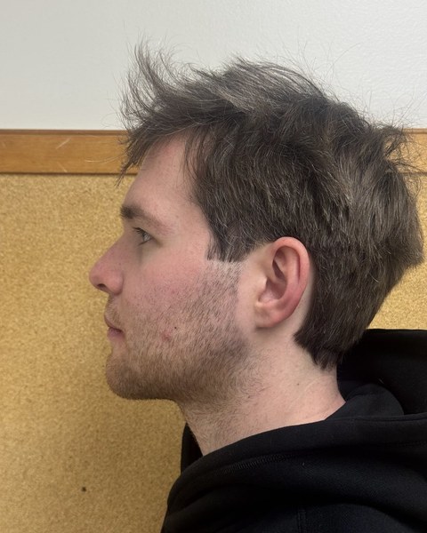 Patient 4 after orthognathic surgery, profile view