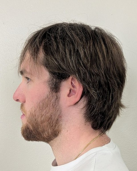 Patient 4 before orthognathic surgery, profile view