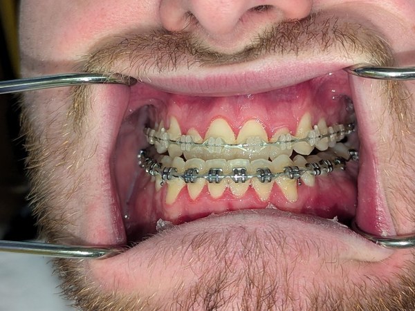 Patient 4 teeth in braces before orthognathic surgery