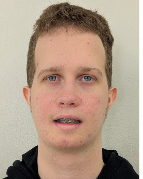 Patient 5 after orthognathic surgery, frontal view