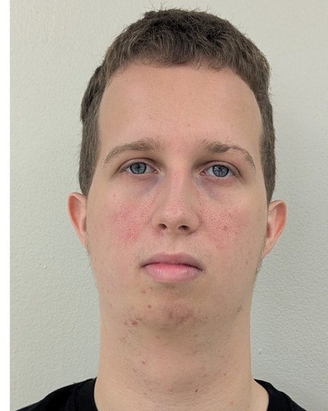 Patient 5 before orthognathic surgery, frontal view
