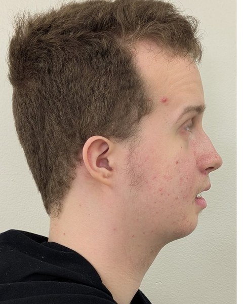 Patient 5 after orthognathic surgery, profile view