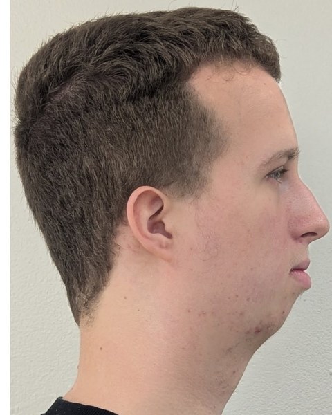 Patient 5 before orthognathic surgery, profile view