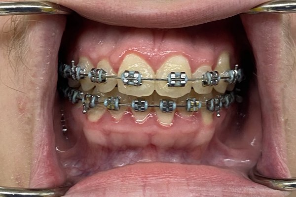 Patient 5 bite before orthognathic surgery