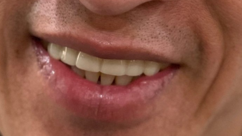 After upper All-on-Four dental implant procedure