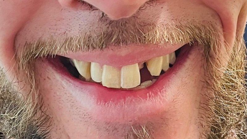 Before full smile transformation with dental implants