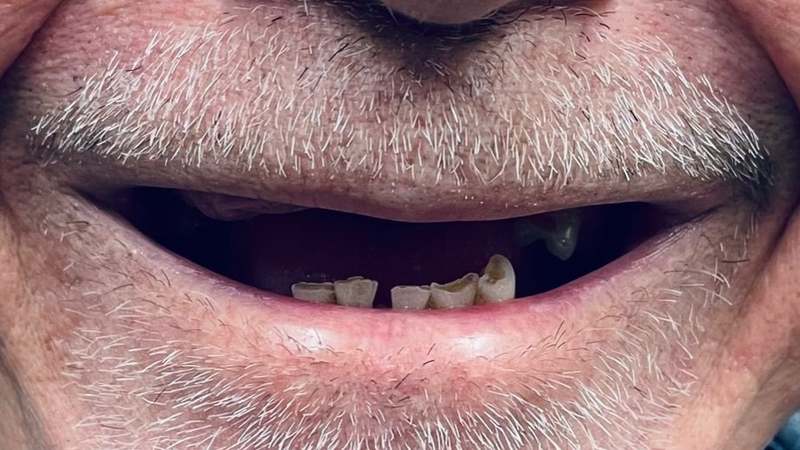 Before replacing partial denture with dental implants