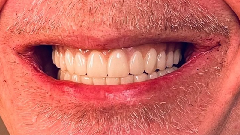 After replacing partial denture with dental implants