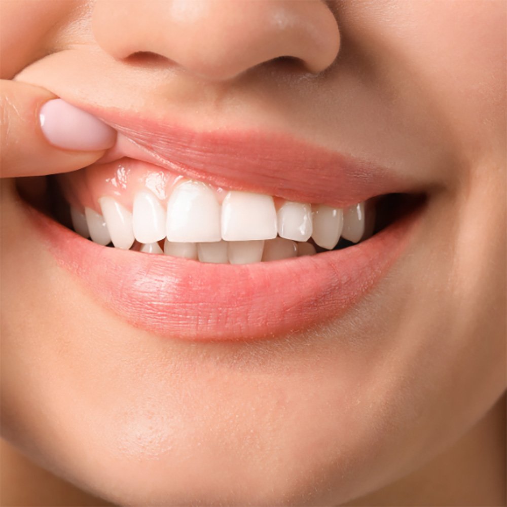 Crown lengthening procedure at Charles County Surgical Arts